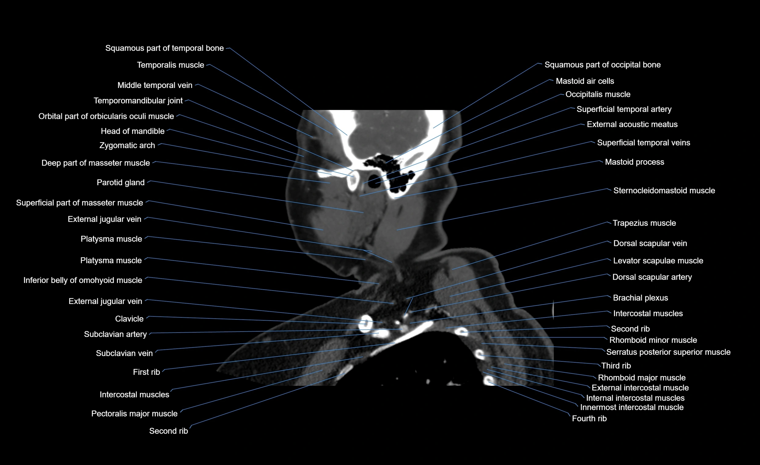 Neck CT sagittal cross sectional anatomy 3D  radiology  image-img-00001-00021.webp